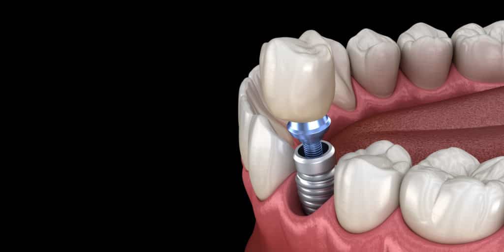 عکس 1 واحد ایمپلنت دندان