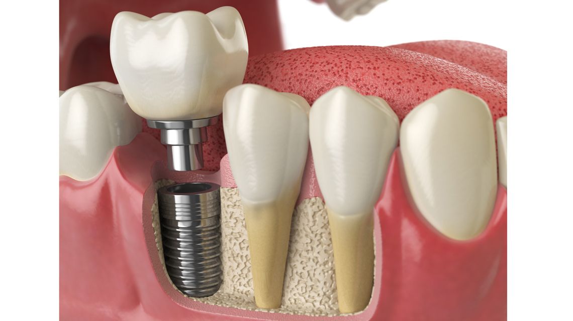 ایمپلنت دندان چیست | مزیت های ایمپلنت های دندانی | دکتر واحدی فردیس کرج