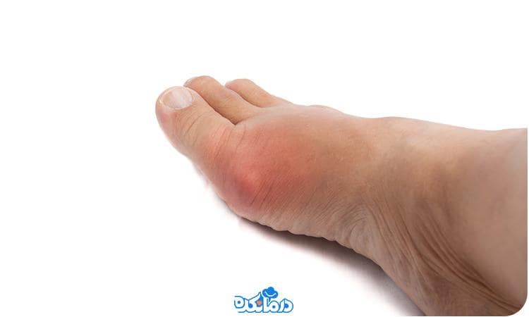 What is the cause of gout?