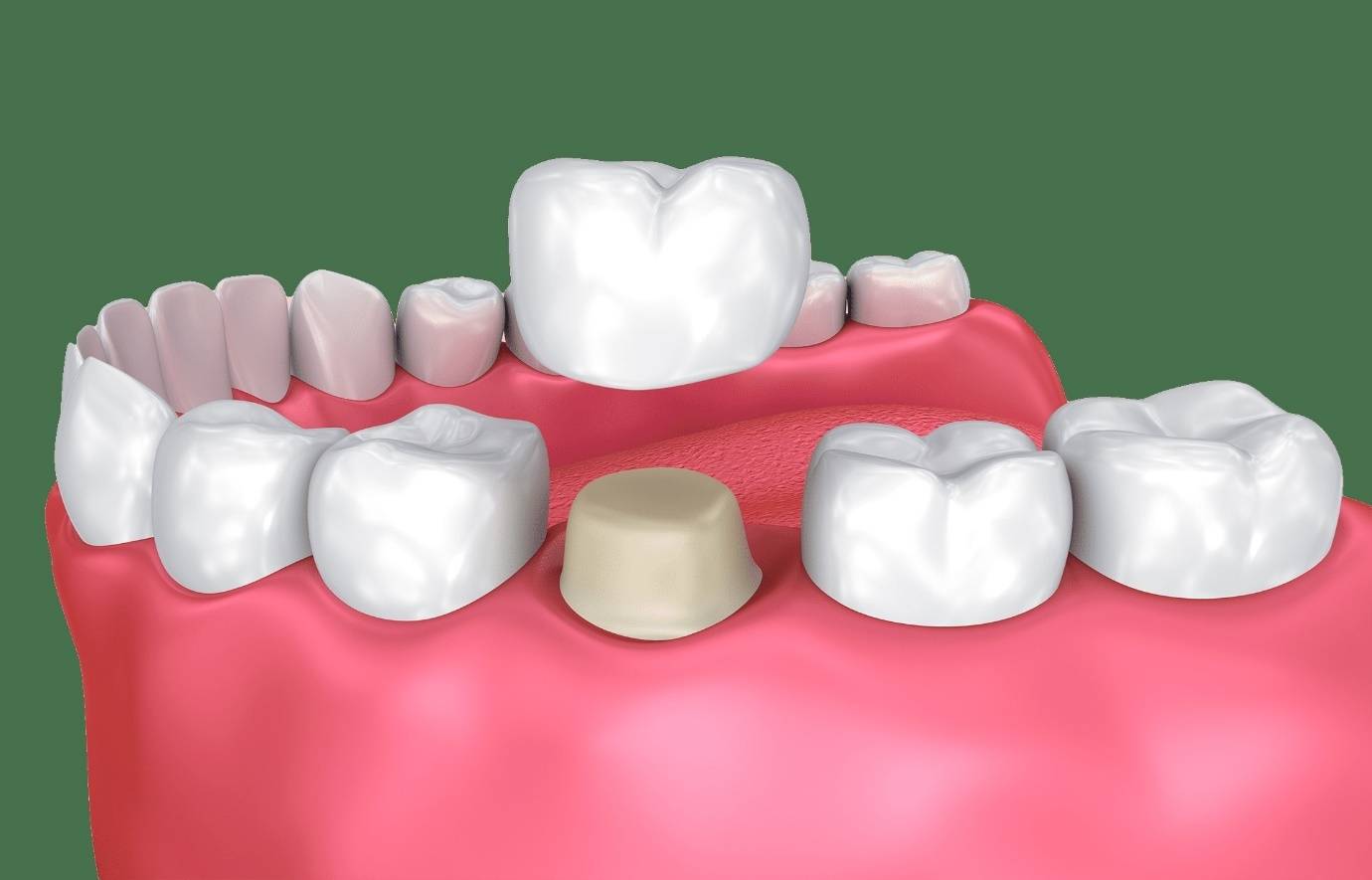 لمینت متحرک دندان را از کجا بخریم؟