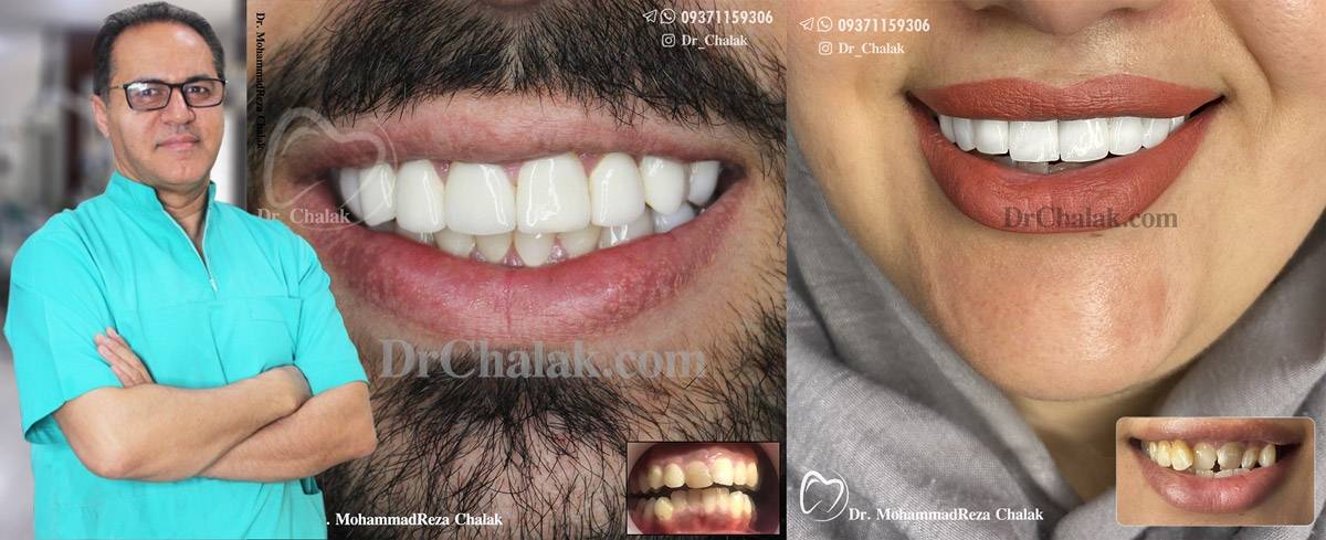 قبل و بعد لمینت دندان مشهد