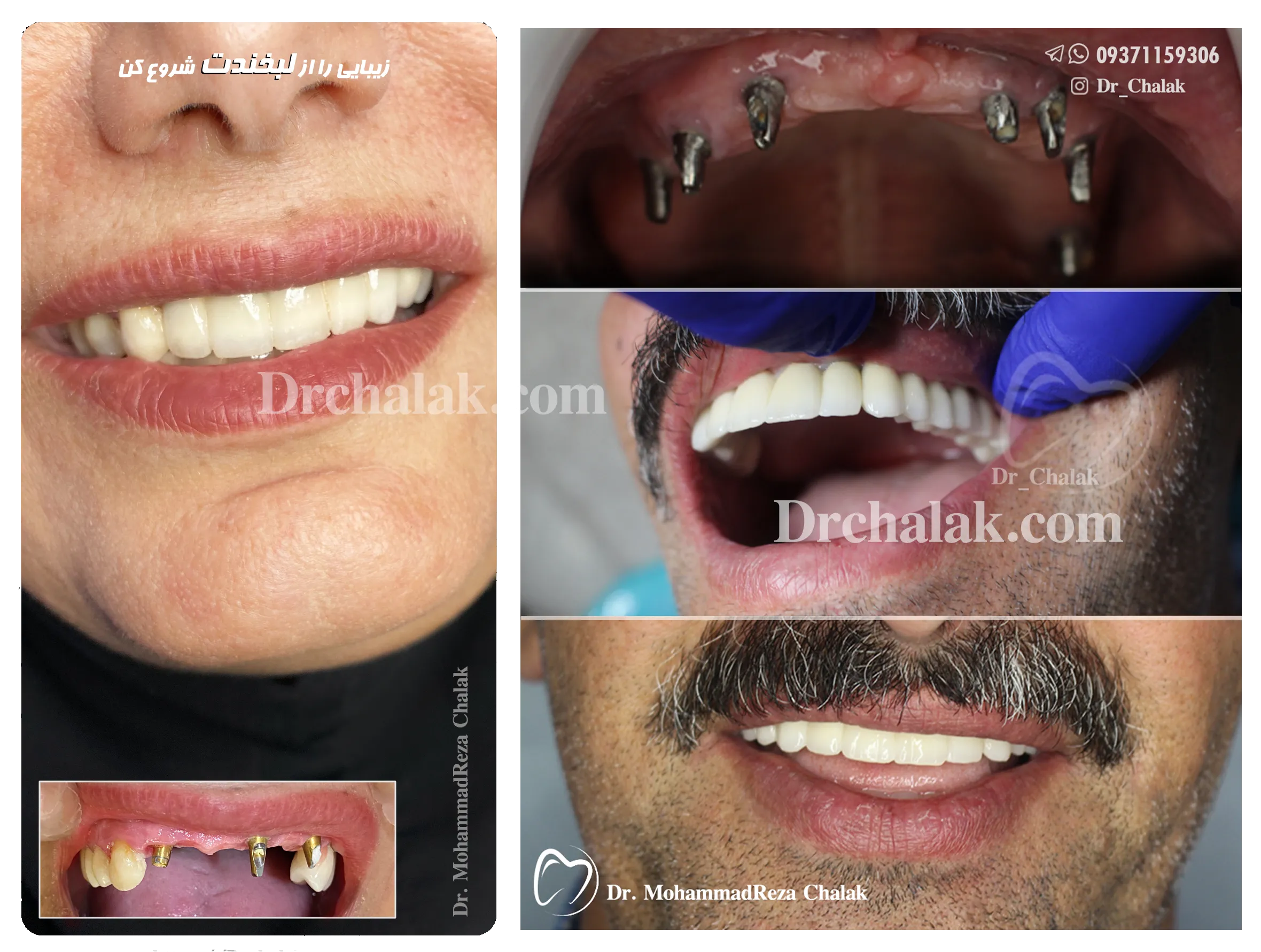 ایمپلنت دندان مشهد